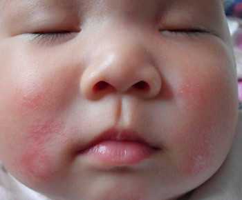 <b>宝宝湿疹严重，反复发作的根治方法</b>