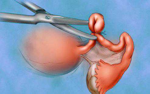 41岁供卵的成功率_高龄产妇头胎后要做绝育手术，为什么医生会建议切除输卵管